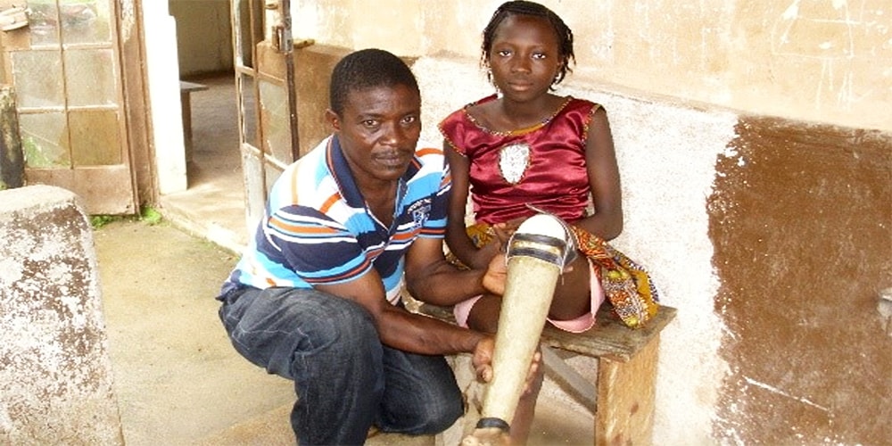 Lappia Amara, director of the Artificial Limb Clinic in Bo, Sierra Leone, fits a limb for Animato Kargbo. 